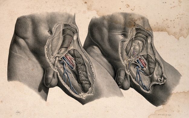 Illustration. The left lower abdomens, hips, and upper thighs of two men are shown from just above the belly button to mid-thigh. The dissected thigh of the left person overlaps the untouched thigh of the other. The example on the right shows deeper dissections, and a few parts are coloured in red and blue in both.