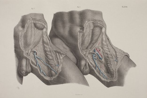 Illustration. The left lower abdomens, hips, and upper thighs of two men are shown from just above the belly button to mid-thigh. The dissected thigh of the left person overlaps the untouched thigh of the other. The example on the right shows deeper dissections, and a few parts are coloured in red and blue in both.